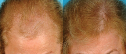 Bauman Turbo Lasercap Sheds New Light On Thinning Hair South