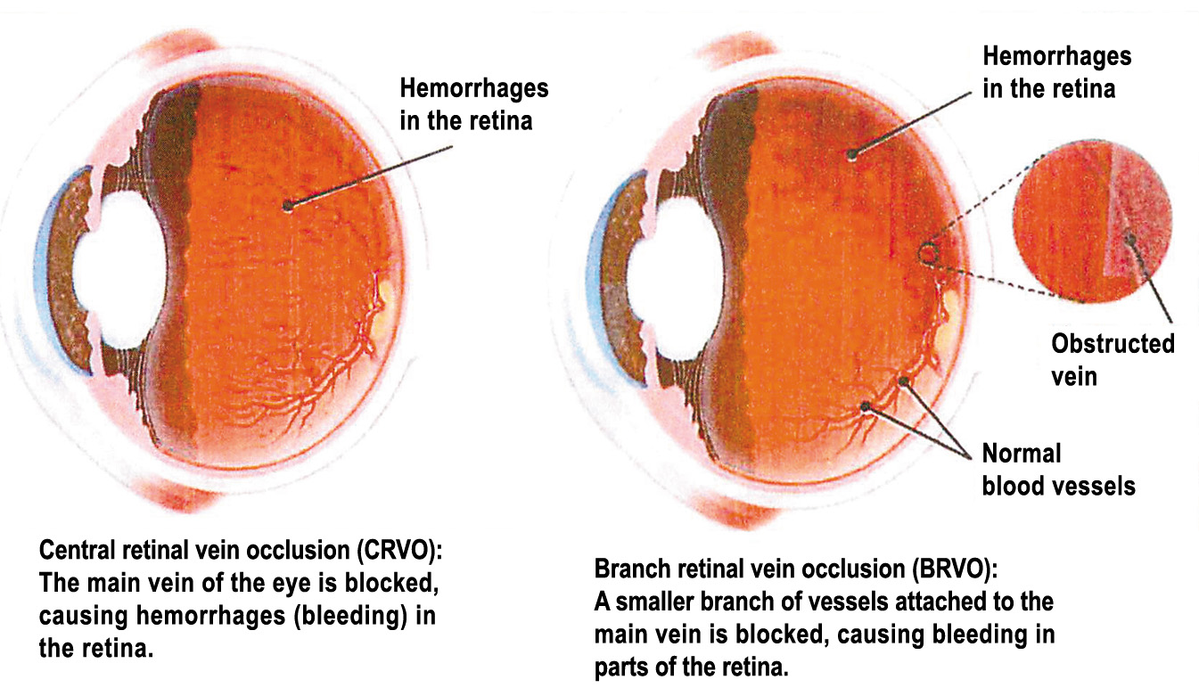 Retinal Vein Occlusion South Florida Health And Wellness Magazine