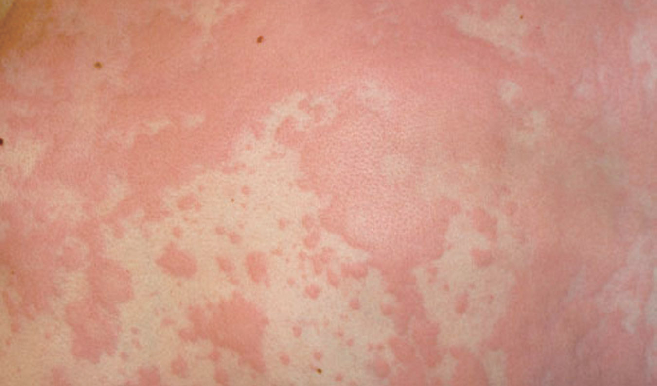 “HIVES AND GIANT HIVES” (Urticaria and Angioedema) South Florida
