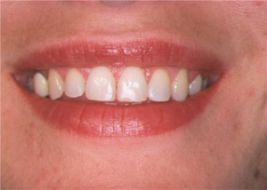 Reducing The Excess Gum to Enhance Your Smile