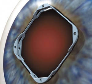 Repairing Complications from Cataract Surgery