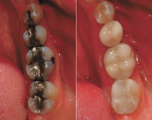 Are your silver fillings making you Sick