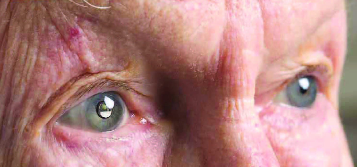 a-new-cataract-surgery-for-those-with-macular-degeneration-south