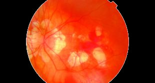 What Is Macular Telangiectasia