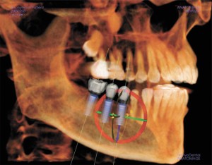 Dental CT Scans