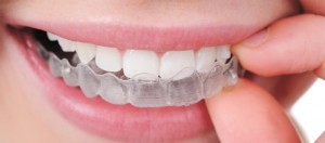 Aesthetic Orthodontic Treatment: It’s Hidden!