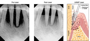 A Painless Way to Treat Gum and Bone Loss