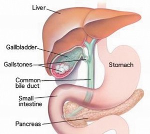 Gallstones