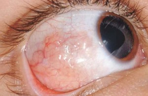 What Is Eye Lymphoma