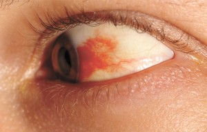 What Is a Subconjunctival Hemorrhage