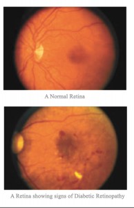 What Is Diabetic Retinopathy