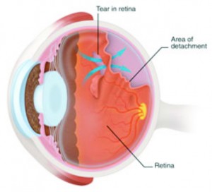 Retinal Tear