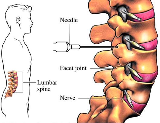 FACET JOINT INJECTIONS FOR BACK PAIN