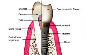What Are The Differences Between a Tooth and a Dental Implant
