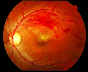 What Is Branch Retinal Vein Occlusion (BRVO)