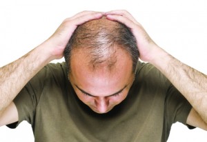 5 Things Even Your Dad May Not Know About Male Pattern Baldness
