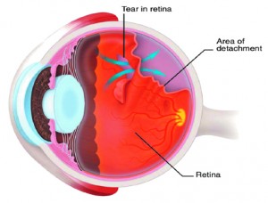 Retinal tear and retinal detachment