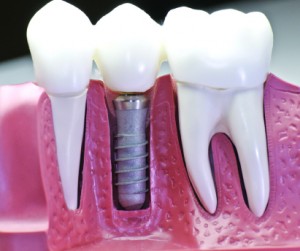 dental-implants