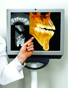 Can A Dental Implant Procedure Really Be Performed in 15 Minutes?