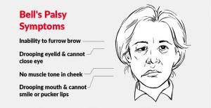 What Is Bell's Palsy?