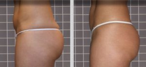 Firm and Remodel Buttocks Frequency 2 sessions per week / 1 week of treatment  – 3 cm reduction
