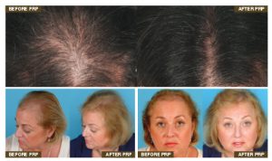 Laser Therapy for Hair Loss: What You Need to Know