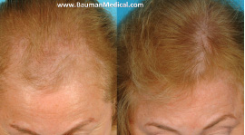 Female before and 12 months after laser therapy with a portable, hands-free laser device