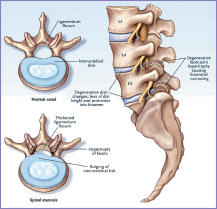 A Gentle Approach to Spinal Stenosis