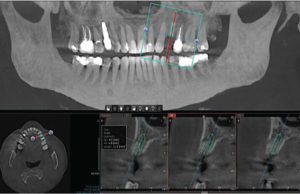 5 Second Low Dose CT Scans for Dental Surgery