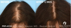 Before and  12 months After PRP+ECM Platelet Rich Plasma with Extracellular Matrix by Dr. Alan Bauman.