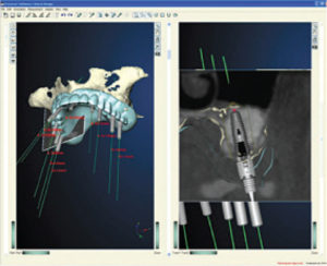 Computer CT Guided  Dental Implant Surgery: Implant Procedures  with No Incisions