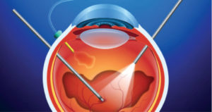 Macular Hole