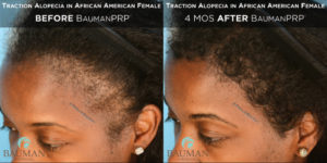 Traction Alocepia before and 4 months After PRP by Dr. Alan Bauman