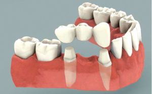 Replacing Missing Teeth – More Options than You May Think