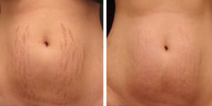 What can you do for  cellulite and  stretch mark improvement?