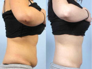 CoolSculpting