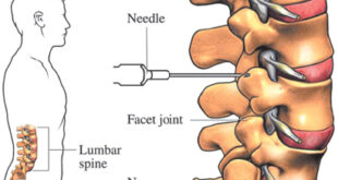 FACET JOINT INJECTIONS