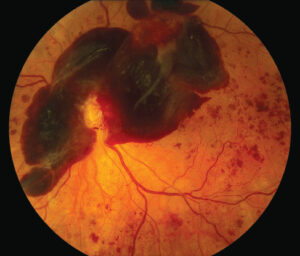 Diabetic Retinopathy