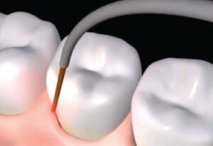 LANAP: A Painless Way to Treat Gum and Bone Loss