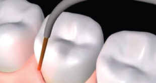LANAP: A Painless Way to Treat Gum and Bone Loss