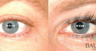 Eyelash Transplants