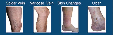 Unsightly Veins Can Indicate Deeper Problems – South Florida Health and ...