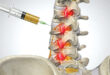 back pain Treatment