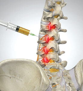 back pain Treatment