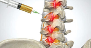 back pain Treatment