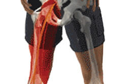 Back Pain