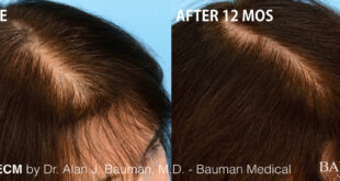 Stress Management for Hair