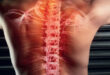 Spinal Stenosis Pain