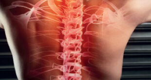 Spinal Stenosis Pain